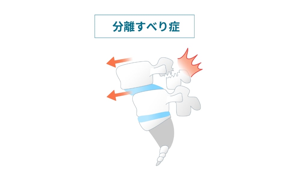 腰椎分離すべり症のイラスト