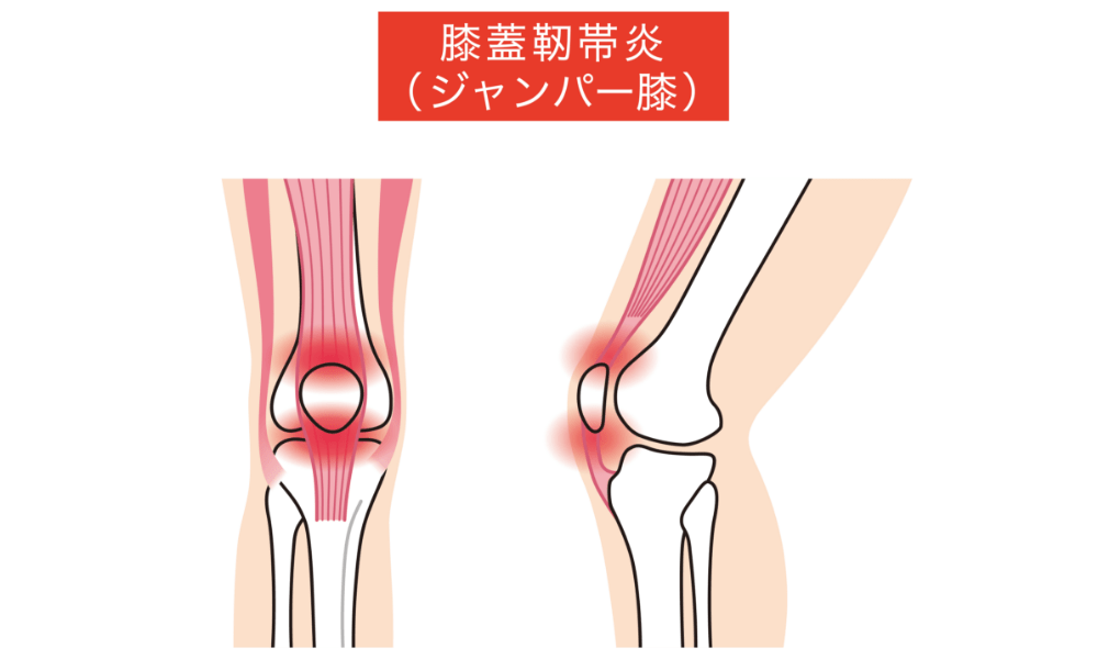 ジャンパー膝