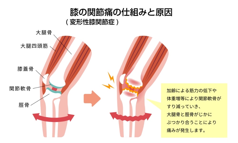 変形性膝関節症の仕組みと原因